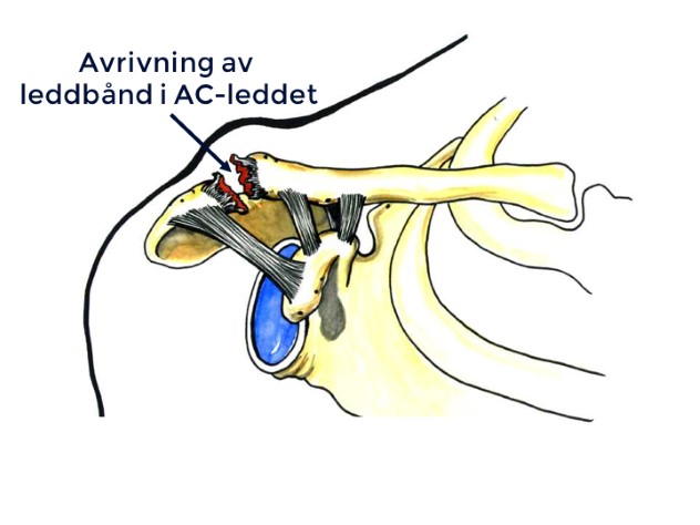 Det finnes flere alvorlighetsgrader av skader på AC-leddet, men de fleste tilfellene behandles konservativt (uten operasjon).