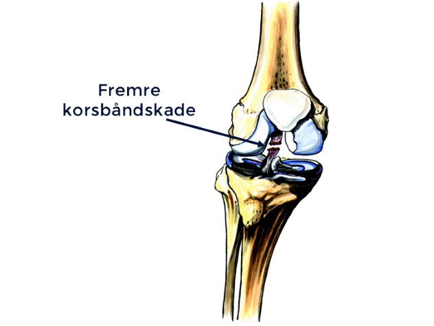 Når det fremre korsbåndet er skadet, betyr det i de aller fleste tilfeller at det er røket. En slik skade fører til lange skadeavbrekk (ofte inntil 12 måneder) og øker risikoen for artrose (slitasjegikt).