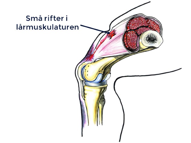 Vanlige symptomer er smerte og ømhet i det skadde området når man tøyer ut, og når man strekker ut kneet med motstand.  Hvis strekkskaden er kraftig nok, kan muskelen bli revet helt av.